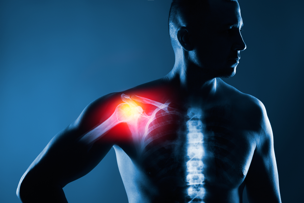 Can Shockwave Therapy Actually Help a Damaged Shoulder Heal? What a Landmark 2003 JAMA Study Found